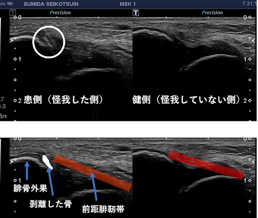 超音波エコー検査にて、子供の足関節の骨折を説明している画像。