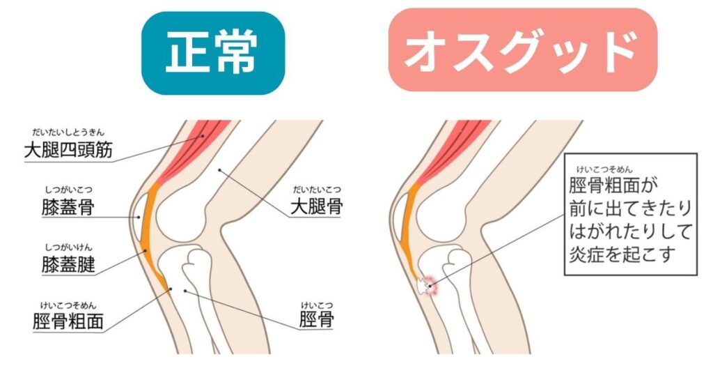 正常な膝とオスグッドになった膝を比べながら説明をしている写真