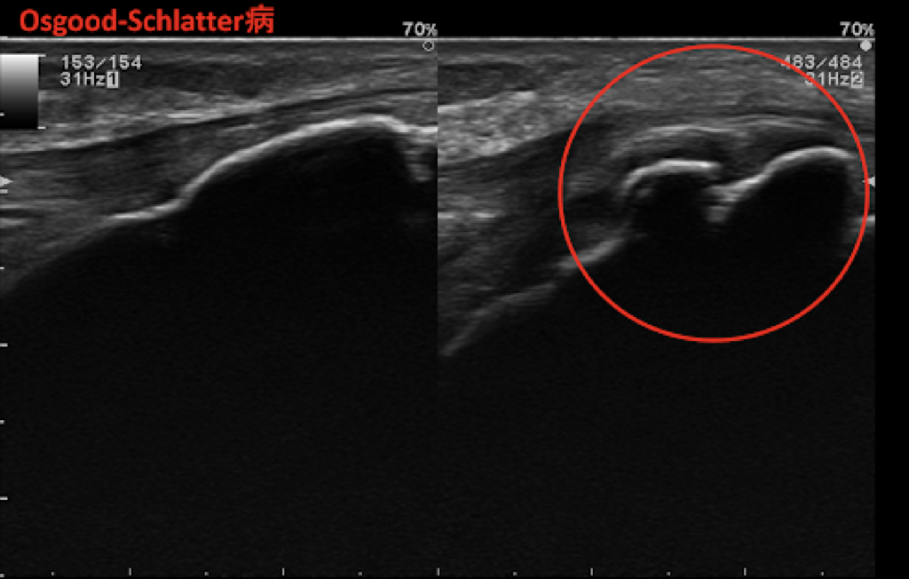 エコー検査でオスグッドの状態を画像で確認している写真