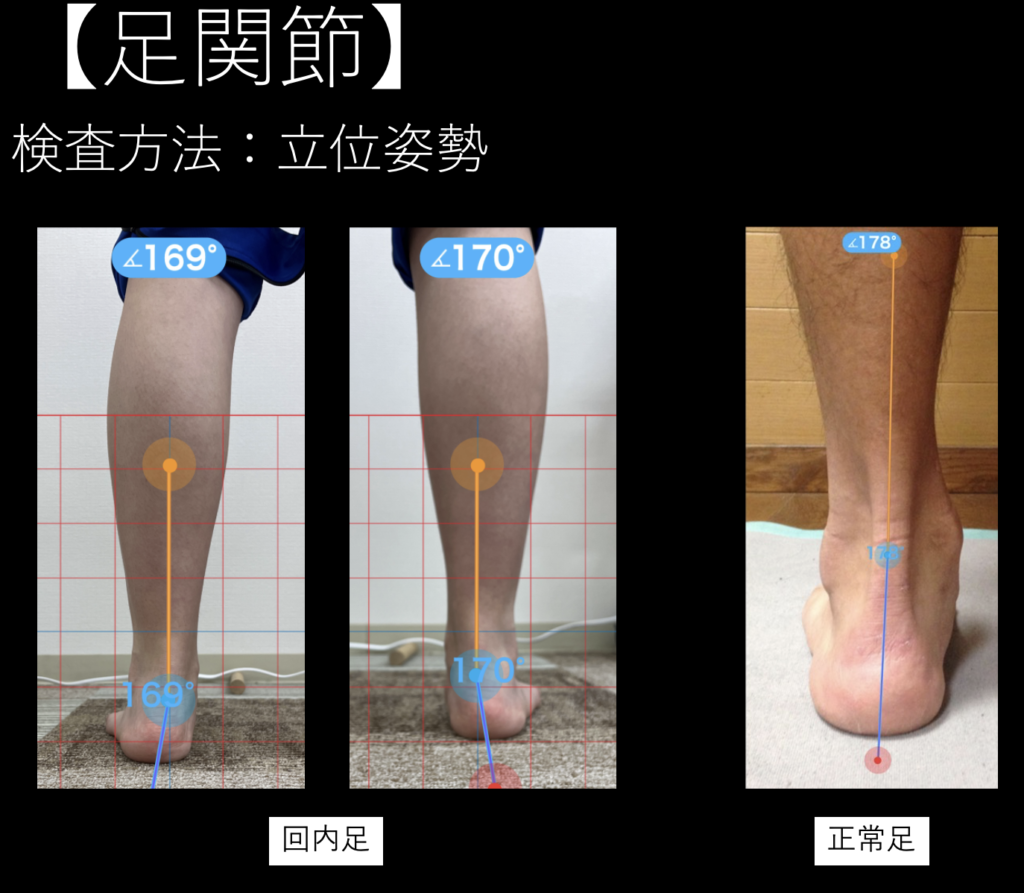 踵の痛みの原因となる扁平足について説明している写真
