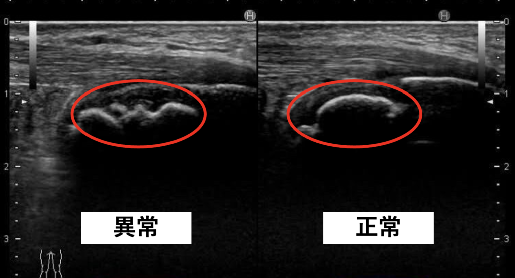 超音波エコーで踵の痛みの原因を説明している写真