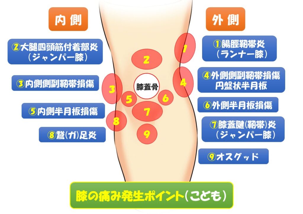 スポーツのケガで腸脛靭帯炎（ランナー膝）以外のケガについて説明している写真。