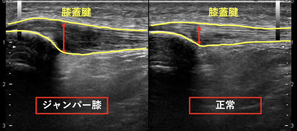 超音波エコーで膝の痛みの原因について画像の説明をしている写真