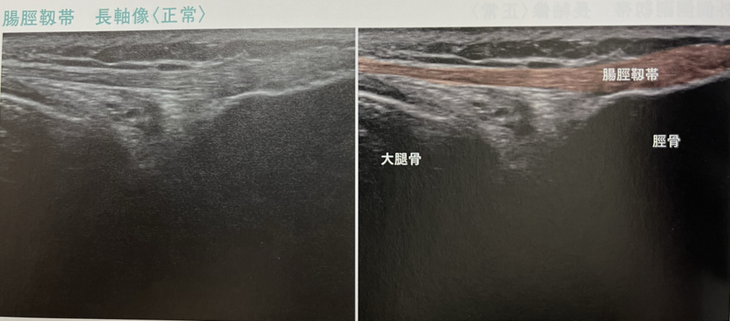 超音波エコー検査にて腸脛靭帯炎（ランナー膝）を調べている写真