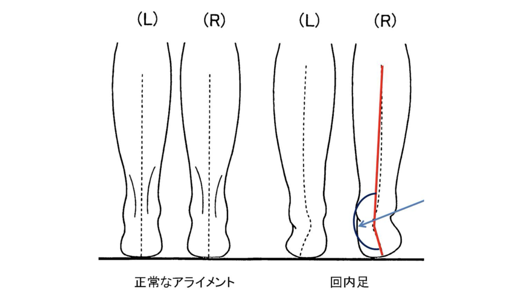 シンスプリント（内側脛骨ストレス症候群）の原因である回内足になっていないかを調べるための検査方法について説明している写真