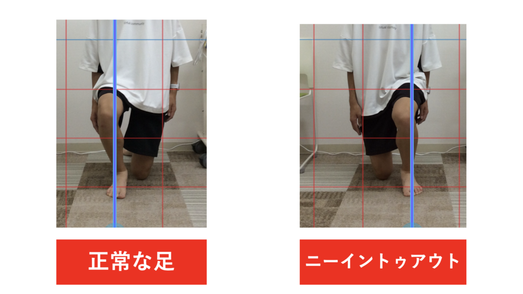 シンスプリント（内側脛骨ストレス症候群）の原因であるknee in toe outになっていないかを調べるための検査方法について説明している写真