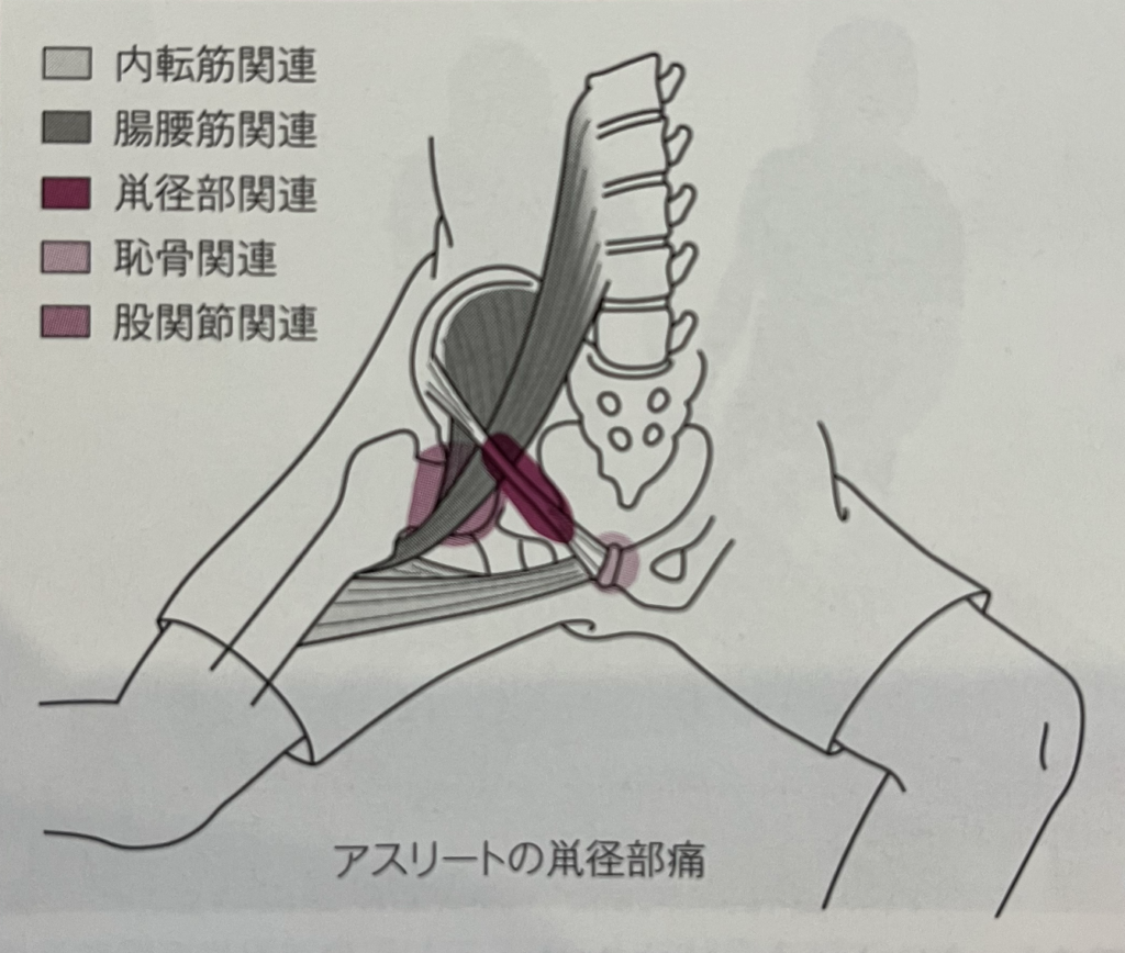 股関節（鼠径部）の痛みの原因について説明をしている写真