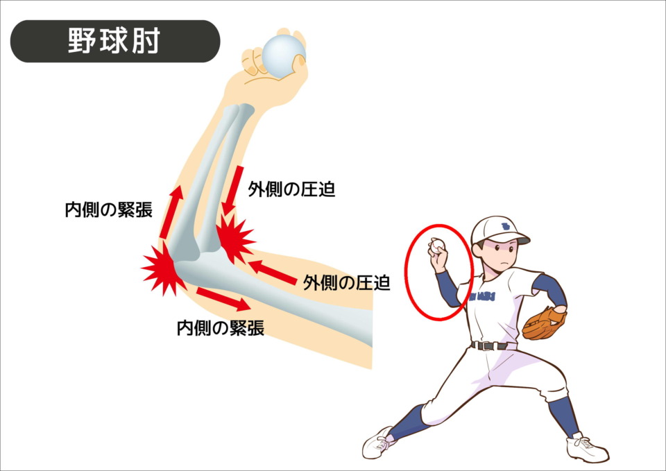 野球肘の原因について説明をしているイラストの写真。
