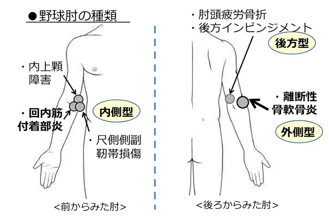 野球肘について内側型、外側型、後方型について説明をしている写真