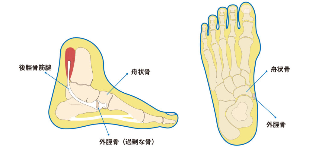 足の痛み（有痛性外脛骨）の症状について説明をしている写真