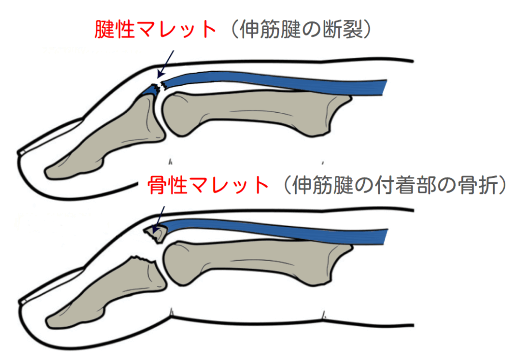 指のケガ(突き指)について説明をしている時の写真