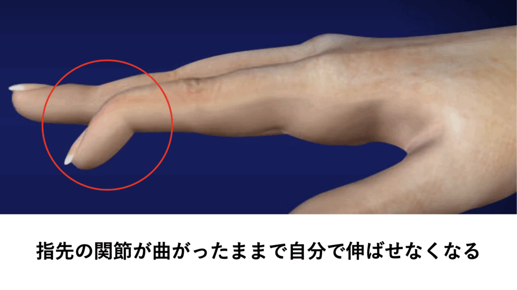 自宅でできる指の痛み(突き指)の原因を調べるため検査方法の説明をしている写真。