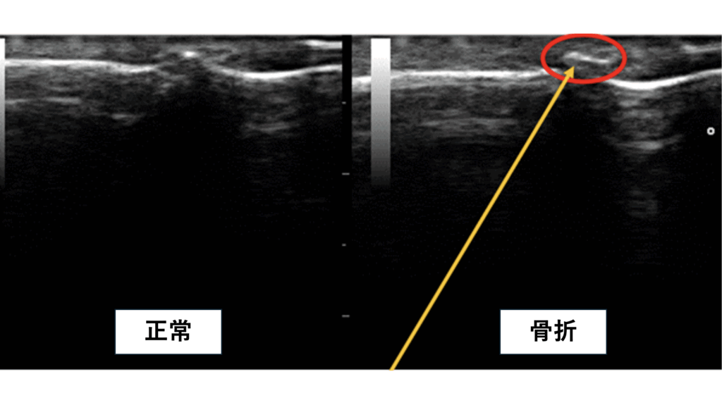 超音波エコーを使って指の痛み(突き指)の原因を調べている時の写真。