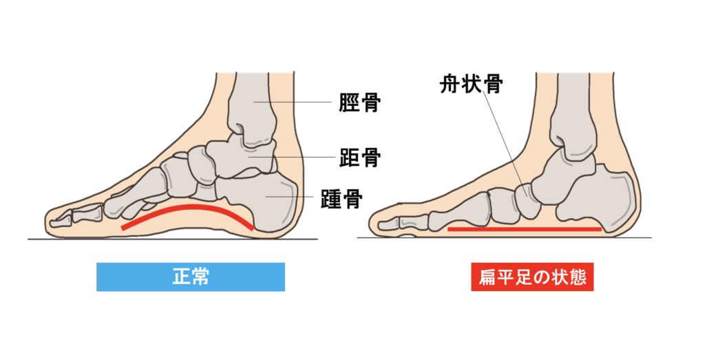 足首の痛み（後脛骨筋腱炎）の原因が扁平足（回内足）で起こることを説明している写真