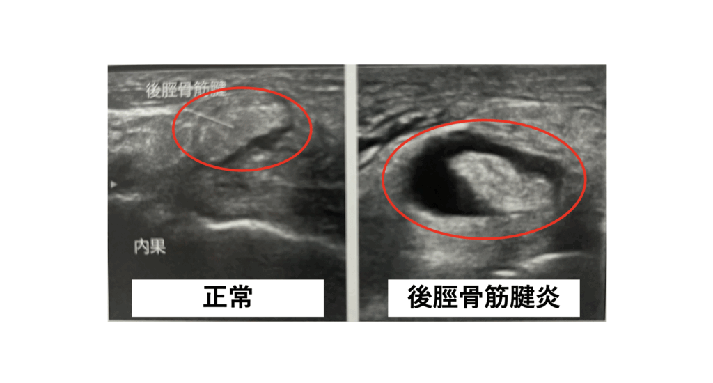 足首の痛み（陸上・バレーボール）の原因を超音波エコーを使って調べている時の写真。