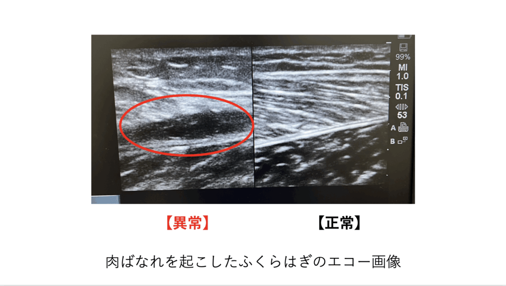 スポーツ中に起こした肉離れの怪我や痛みの原因を超音波エコー検査の写真