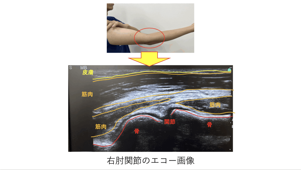 超音波エコー検査を使って筋肉や関節、骨などの運動器を画面を介して観察する写真