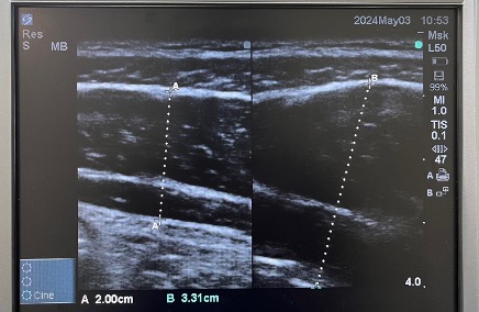 運動機能検査(フィジカルチェック)で体幹機能を調べるために超音波エコー検査を使って体幹の内部を観察している時の写真