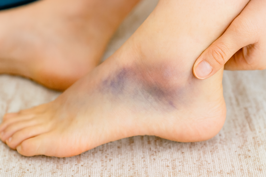 捻挫をしてしまい、内出血を起こした足首の写真。
