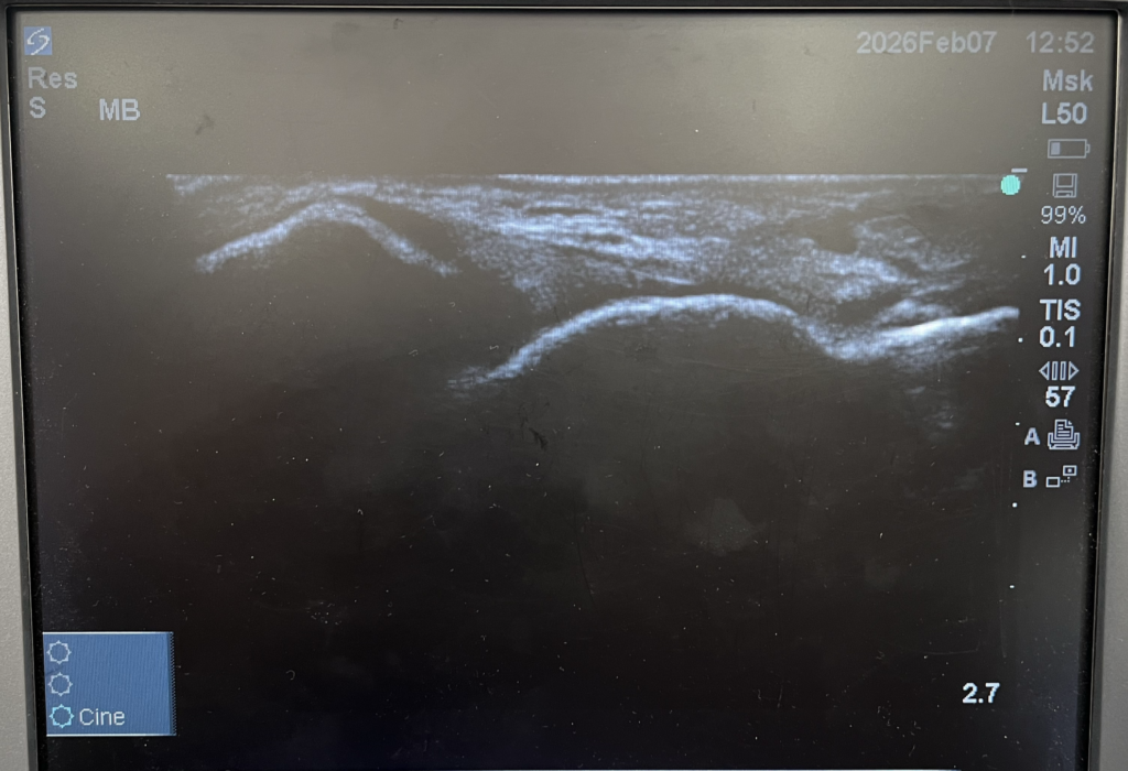 超音波エコーにて足首の靭帯をうつしている写真