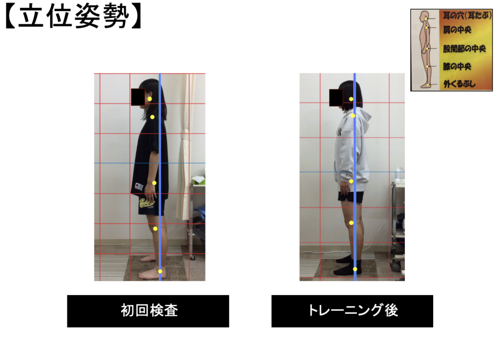 トレーニング前後の姿勢の変化を比較している写真。