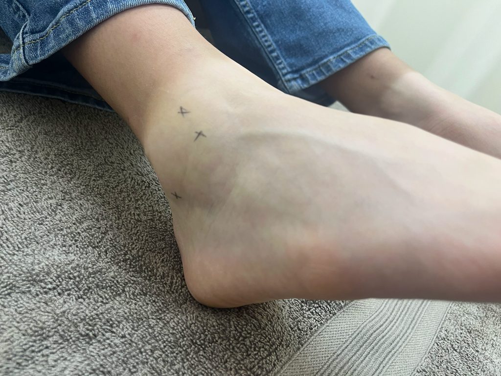 足首のけが(捻挫)で外側のくるぶしあたりが腫れている時の写真。